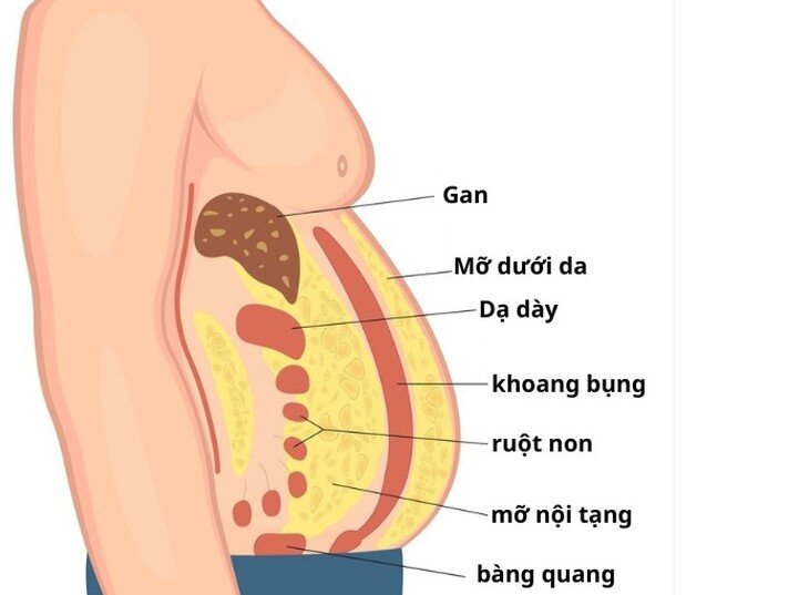 1783727198-624f0d91f7-mo-noi-tang-15789-width730height537 Quá nhiều mỡ nội tạng làm tăng nguy cơ mắc nhiều bệnh mạn tính nguy hiểm.