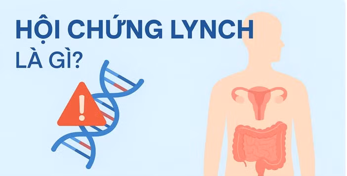 Hội chứng Lynch - hội chứng ung thư di truyền do đột biến gen và có thể truyền từ thế hệ này sang thế hệ khác