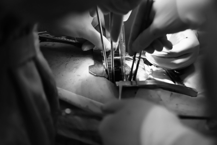 Thay vì phải cắt bỏ toàn bộ lá phổi, phẫu thuật Sleeve chỉ cắt bỏ phần phổi chứa khối u cùng đoạn phế quản bị xâm lấn, sau đó tái tạo đường thở bằng cách nối phần phế quản còn lành.  (ảnh: BVCC)