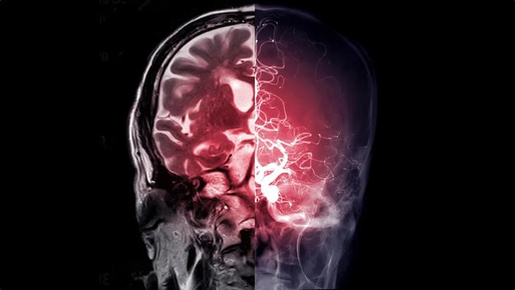 1785636485-d44057c83f-brain-glow-scan-jpg-55033-width730height411 Não bộ mới chính là trung tâm điều khiển quan trọng giúp metformin phát huy tác dụng hạ đường huyết khi sử dụng ở liều lượng điều trị thông thường. Hình minh họa: Shutterstock