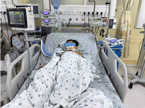 Em trai út tên Â. được chẩn đoán ngộ độc thuốc diệt chuột nghi loại siêu warfarin, biểu hiện nặng nhất xuất huyết da niêm, nội tạng, suy hô hấp, được điều trị tích cực, phục hồi dần.