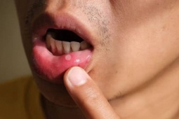 Tự ý ngừng thuốc chữa nhiệt miệng, người đàn ông mù một mắt