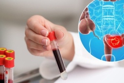 Ung thư đại trực tràng: Những dấu hiệu cảnh báo không nên bỏ qua