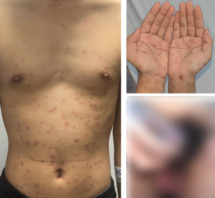 Tổn thương ban đỏ lan tỏa ở tay chân, thân mình, sinh dục của bệnh nhân khi nhập viện.Ảnh BVCC