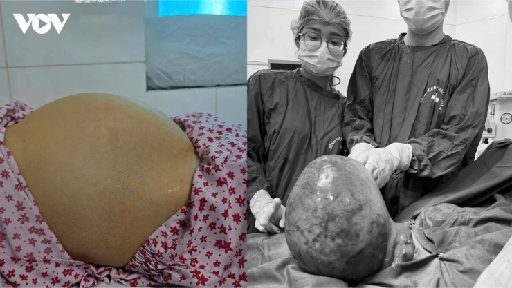 Bụng to bất thường, người phụ nữ Hà Nội bất ngờ với khối u xơ tử cung 6kg