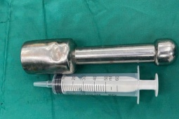 Gắp dị vật trực tràng 18 cm, giúp bệnh nhân tránh mổ hở