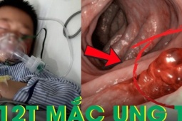 Bé trai 12 tuổi mắc ung thư dạ dày, nguyên nhân khiến ai cũng giật mình