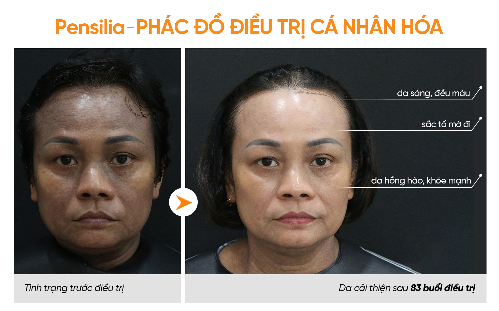 Làn da của khách hàng sau liệu trình điều trị theo phác đồ cá nhân hoá tại Pensilia