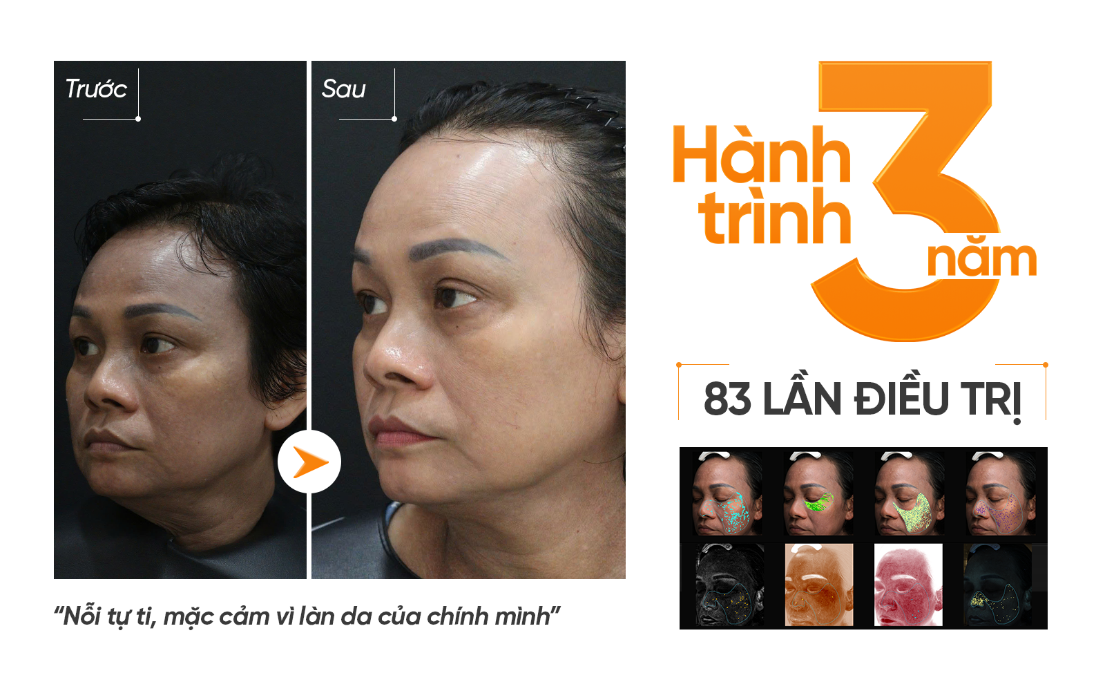 Hành trình 3 năm với 83 lần điều trị của chị Phương Tâm tại Pensilia