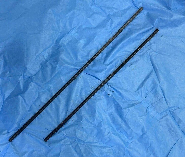 1789985934-fe17b4603f-thanh-sat-dam-qua-nguoi-4264-width730height618 2 thanh sắt được lấy ra sau phẫu thuật. Ảnh: BVCC.