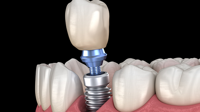 insert-ifanger-gia-cong-implant