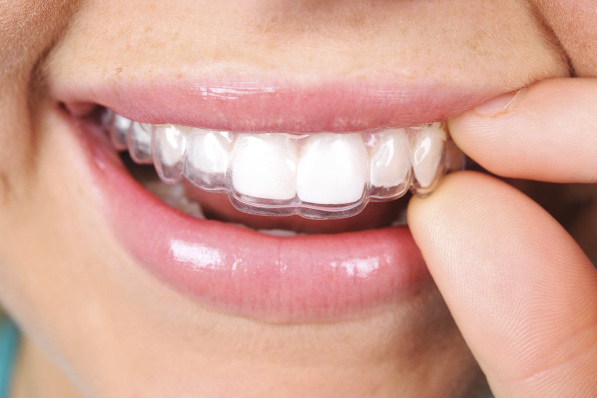Niềng răng trong suốt mang lại hiệu quả chỉnh nha rất tốt (Nguồn: nhakhoalink.vn)