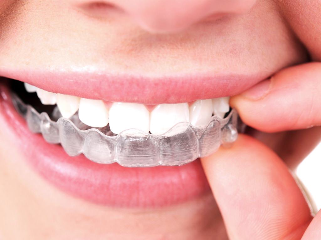 Khay niềng răng Invisalign tiện lợi dễ sử dụng (Nguồn: doctors24h.vn)
