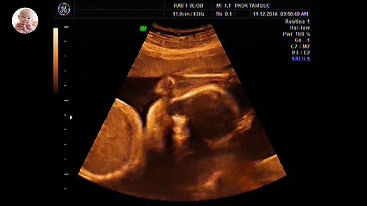 Hình ảnh khám thai 26 tuần tuổi siêu âm 4D