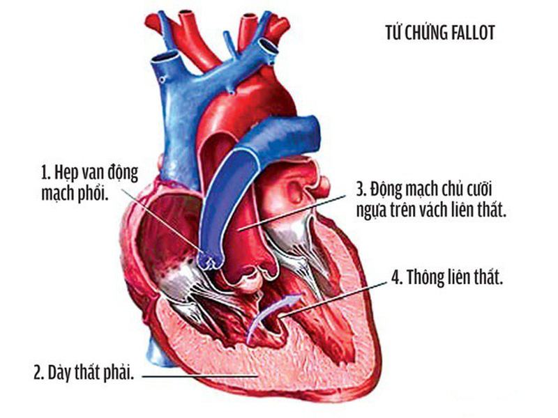 Bệnh tim bẩm sinh thường gặp nhất là dạng thông liên thất