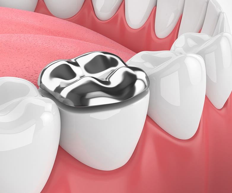 Có rất nhiều loại vật liệu dùng để trám răng