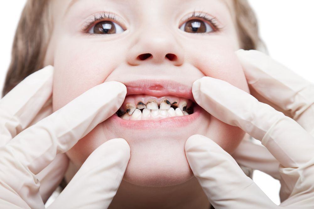 Nhiều phụ huynh tỏ ra xem nhẹ việc răng sữa bị sâu