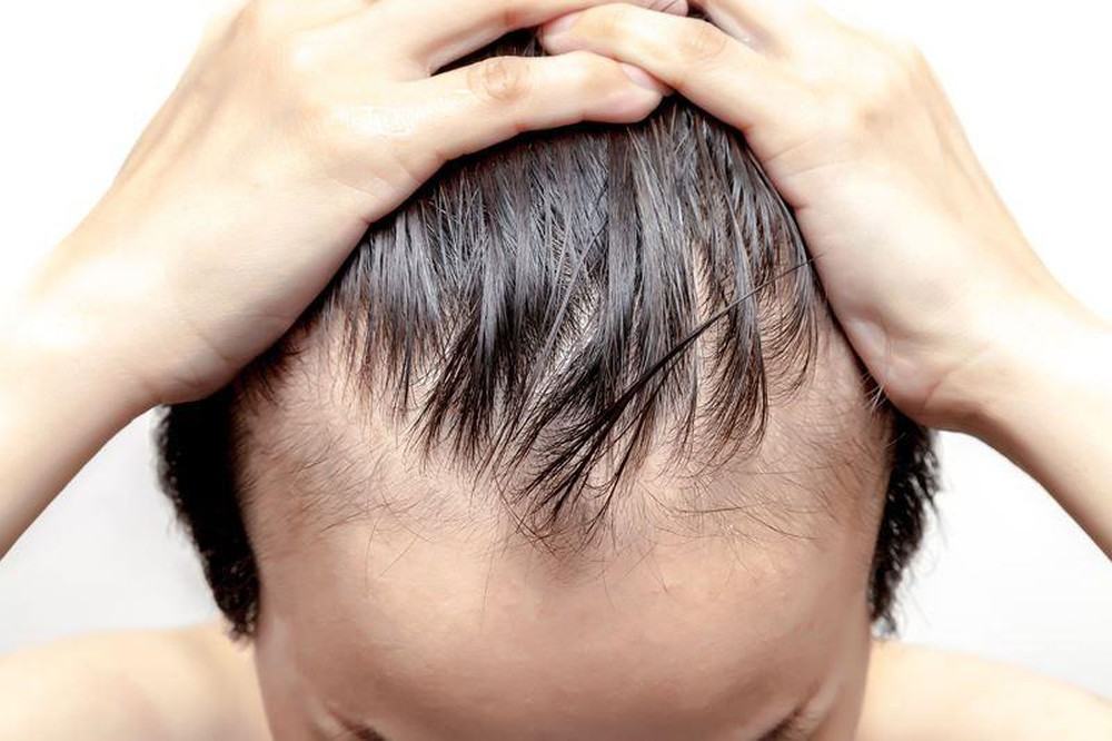 Hói đầu có chữa được không? 5 cách giảm rụng tóc khoa học an toàn