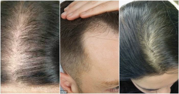 Điều trị rụng tóc ở nam giới