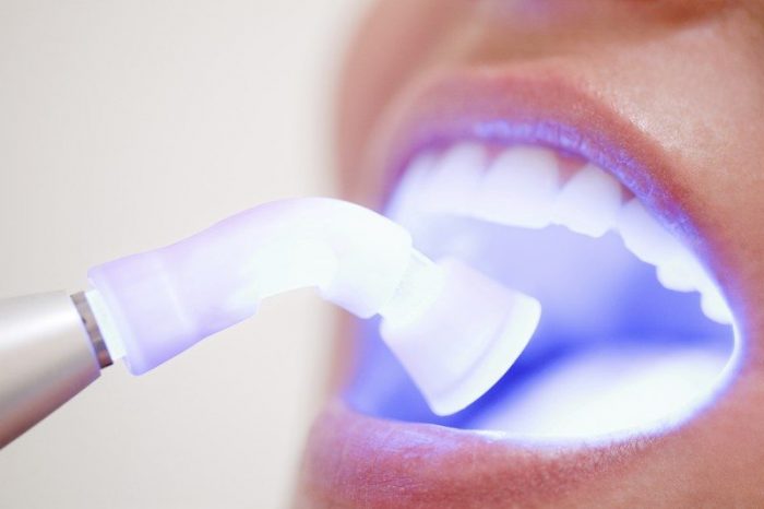 Tẩy trắng răng loại nào tốt nhất: Plasma, Laser, Máng, Than hoạt tính