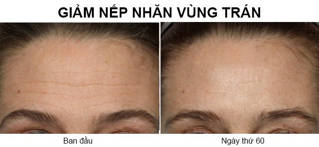 may-massage-nang-co-mat-nuface-trinity-facial-wrinkle-reducer-gift-set-4 - Baotrithuc.vn