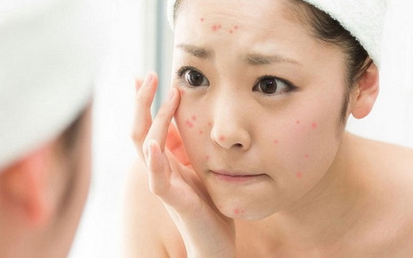 Các bước chăm sóc da mặt bị mụn của chị em giúp phục hồi nhanh chóng