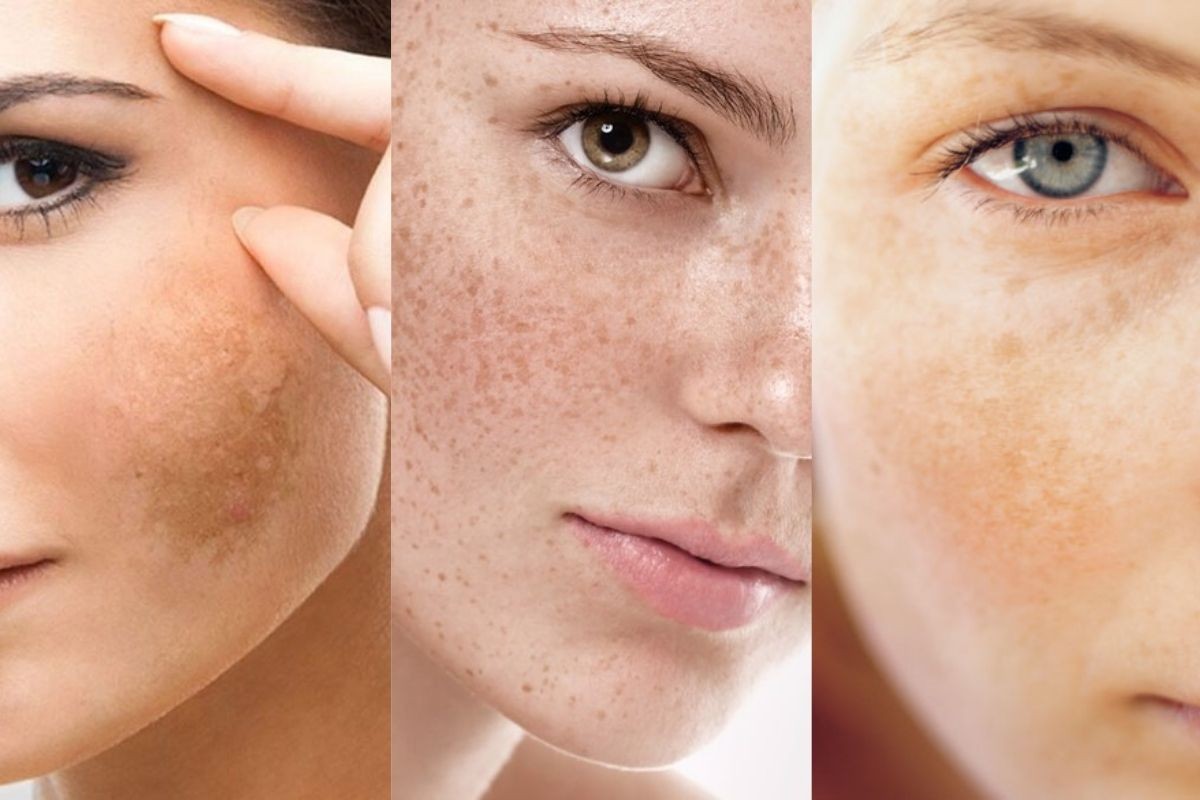 Phân biệt nám da nội tiết tố với nám da thông thường