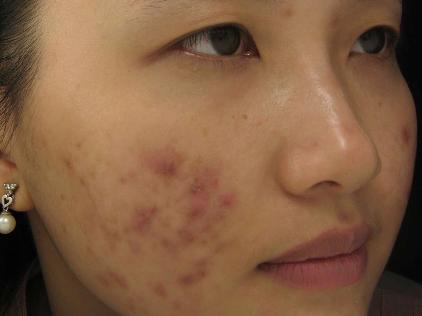 Chăm sóc da mặt khi da bị mụn và sẹo thâm như thế nào?
