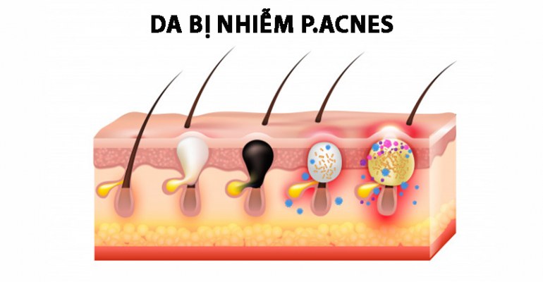vi khuẩn acnes