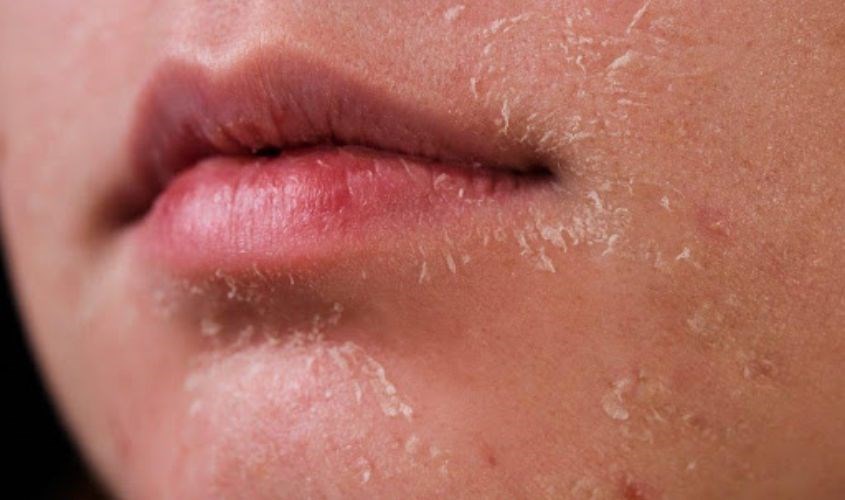 Da khô tróc vảy – Cách ngăn ngừa và chăm sóc hiệu quả
