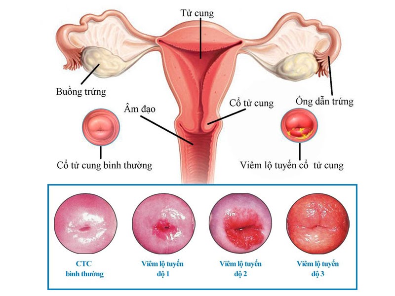 Khâu eo cổ tử cung là kỹ thuật gì, có đau không, chí phí tiến hành