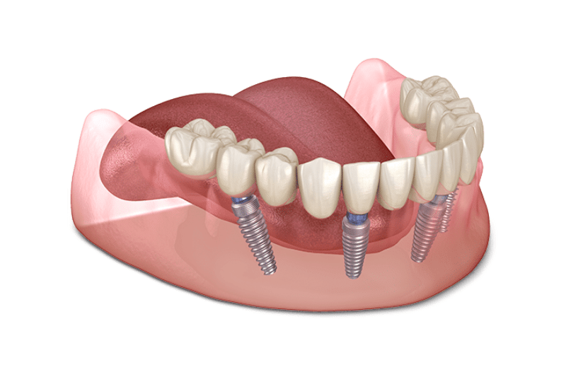 Tìm hiểu 7 lợi ích của trồng răng implant