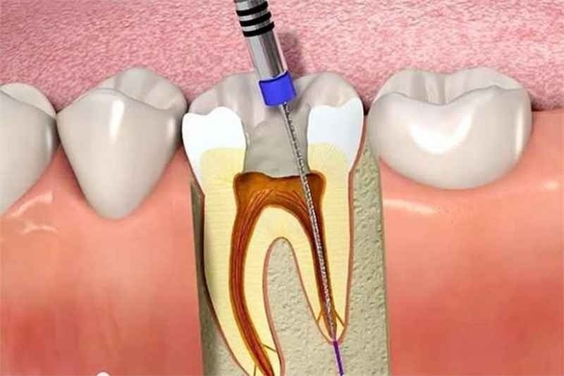 Việc trám răng sâu có cần lấy tủy?