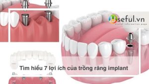 Tìm hiểu 7 lợi ích của trồng răng implant