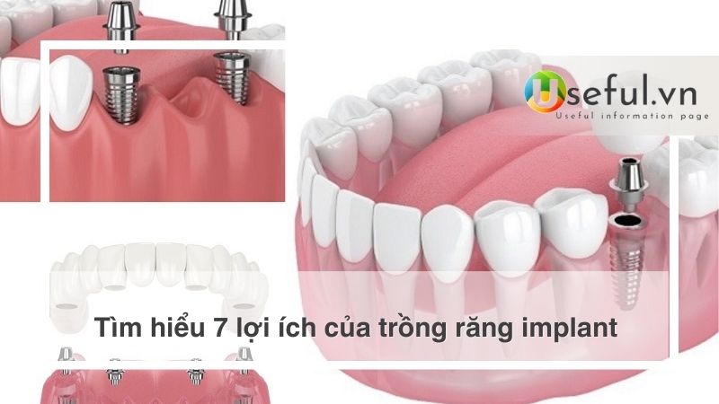 Tìm hiểu 7 lợi ích của trồng răng implant