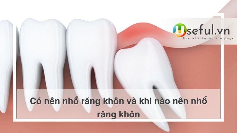 Có nên nhổ răng khôn và khi nào nên nhổ răng khôn