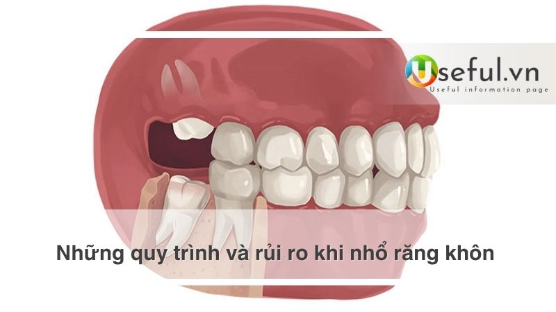 Những quy trình và rủi ro khi nhổ răng khôn