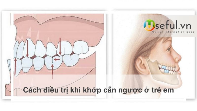 Cách điều trị khi khớp cắn ngược ở trẻ em