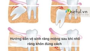 Hướng dẫn vệ sinh răng miệng sau khi nhổ răng khôn đúng cách