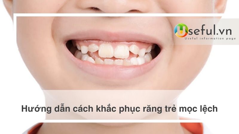 Hướng dẫn cách khắc phục răng trẻ mọc lệch