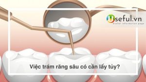 Việc trám răng sâu có cần lấy tủy?