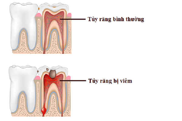 Cách nhận biết khi bị viêm tủy răng