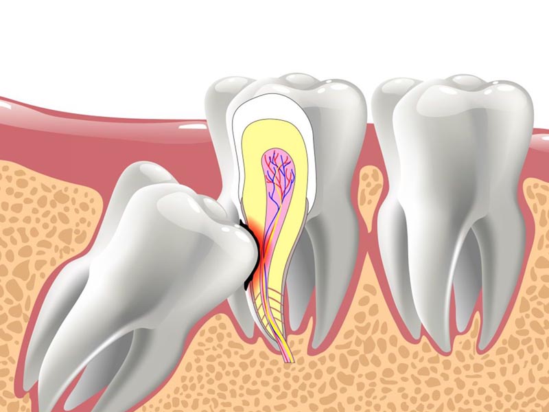 Hướng dẫn vệ sinh răng miệng sau khi nhổ răng khôn đúng cách