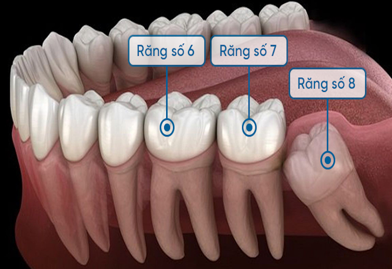 Một số tình trạng mọc răng số 8 phổ biến 1. Răng số 8 mọc đúng hướng (vertical impaction) Răng số 8 mọc đúng hướng, mọc thẳng như vị trí như răng bình thường sẽ không gây ra vấn đề gì cho sức khỏe. Thậm chí, răng khôn mọc đúng hướng không gây đau, viêm nướu hoặc sưng tấy. Đây là dấu hiệu tốt cho thấy xương hàm có đủ không gian cho những chiếc răng vĩnh viễn cuối cùng phát triển bình thường. 2. Răng số 8 mọc chỉ một phần (partial impaction) Răng số 8 mọc 1 phần có thể nhìn thấy được, phần răng không bị ảnh hưởng đã mọc lên và lộ rõ ​​hoàn toàn phía trên đường viền nướu. Chúng mọc chỉ một phần, phần còn lại mắc kẹt trong nướu hoặc xương hàm. Răng số 8 mọc chỉ 1 phần có thể gây ra nhiều vấn đề về sức khỏe răng miệng, bao gồm sâu răng, bệnh nướu răng và nhiễm trùng. 3. Răng số 8 mọc ngang hoặc nghiêng (horizontal impaction): Răng số 8 mọc nghiêng là khi răng khôn ở đúng vị trí để mọc nhưng nó vẫn mắc kẹt bên dưới nướu. Răng mọc ngang bị mắc kẹt bên dưới nướu. Răng khôn mọc ngang hoặc mọc nghiêng thường gây đau vì tạo áp lực