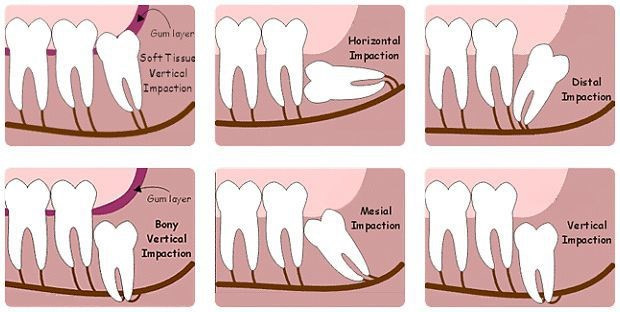 Răng số 8 là răng gì? Tìm hiểu thêm về răng số 8 