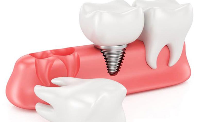 Tìm hiểu 7 lợi ích của trồng răng implant