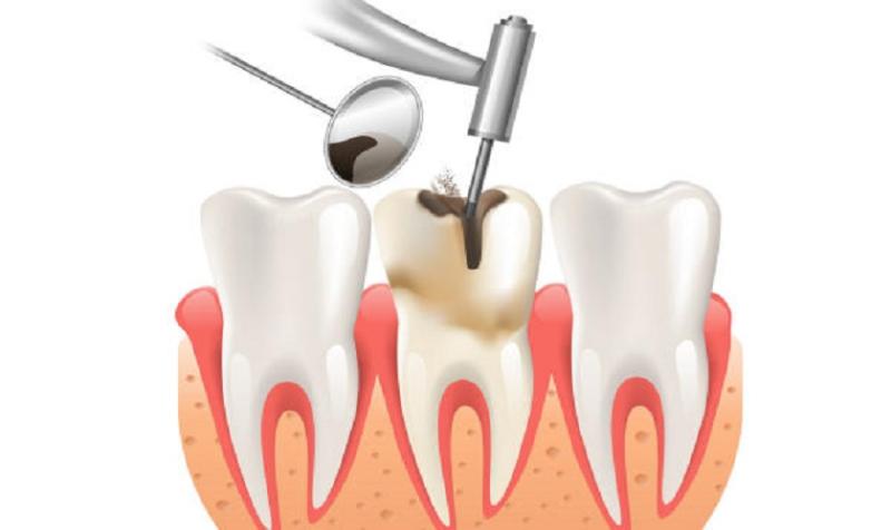 Việc trám răng sâu có cần lấy tủy?