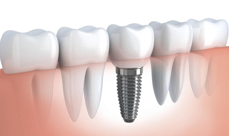 Tìm hiểu 7 lợi ích của trồng răng implant