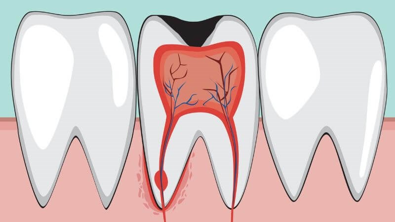 Cách nhận biết khi bị viêm tủy răng