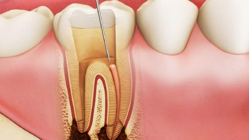 Cách nhận biết khi bị viêm tủy răng